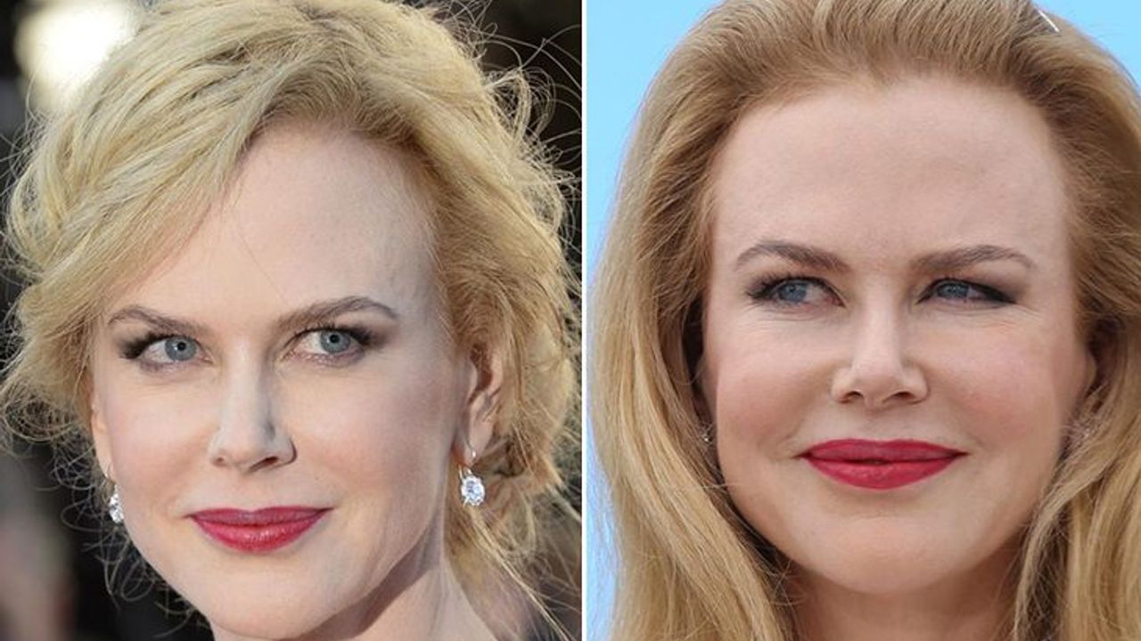 Nicole Kidman before and after plastic surgery