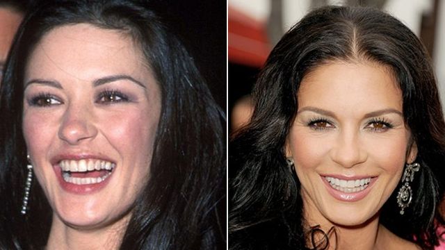 Catherine Zeta-Jones before and after plastics